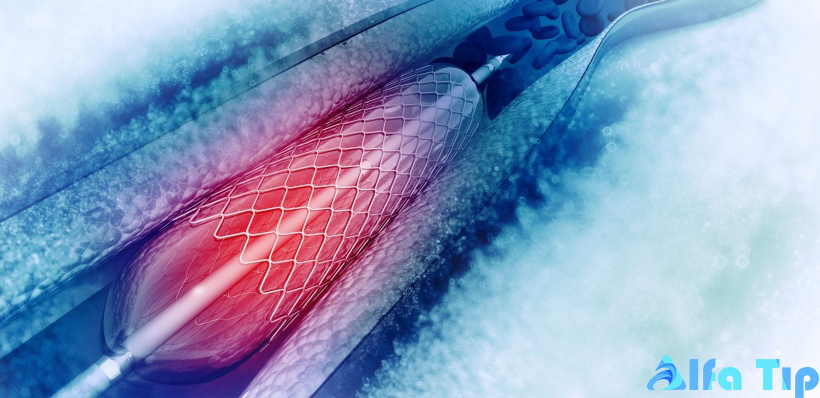 veniflow 35 pta dilatasyon kateteri